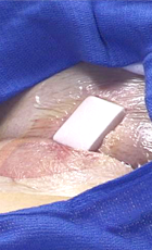 obtain and maintain hemostasis